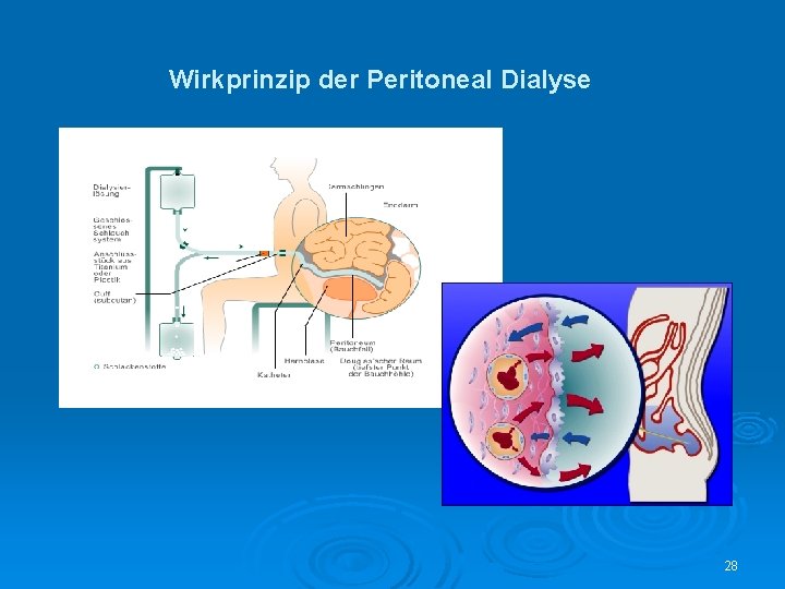 Wirkprinzip der Peritoneal Dialyse 28 