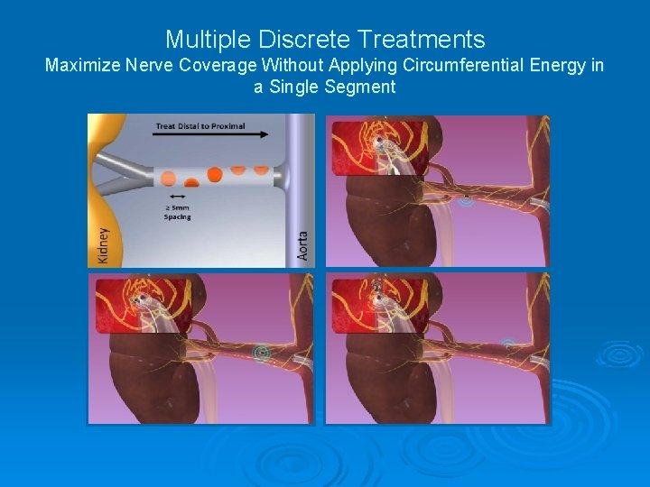 Multiple Discrete Treatments Maximize Nerve Coverage Without Applying Circumferential Energy in a Single Segment