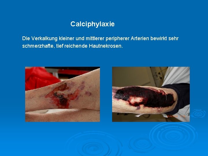 Calciphylaxie Die Verkalkung kleiner und mittlerer peripherer Arterien bewirkt sehr schmerzhafte, tief reichende Hautnekrosen.