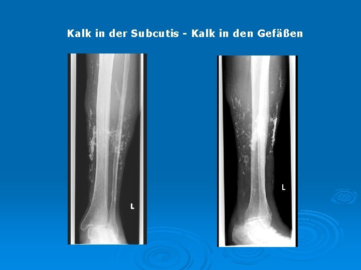 Kalk in der Subcutis - Kalk in den Gefäßen 