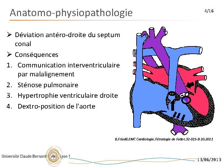 Anatomo-physiopathologie 4/16 Ø Déviation antéro-droite du septum conal Ø Conséquences 1. Communication interventriculaire par