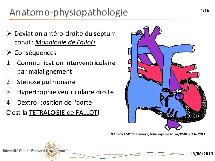 Anatomo-physiopathologie 4/16 Ø Déviation antéro-droite du septum conal : Monologie de Fallot! Ø Conséquences