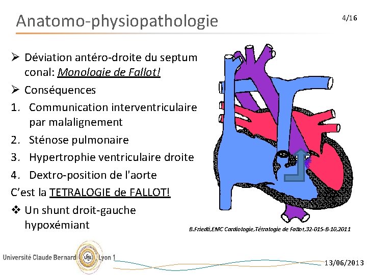 Anatomo-physiopathologie 4/16 Ø Déviation antéro-droite du septum conal: Monologie de Fallot! Ø Conséquences 1.