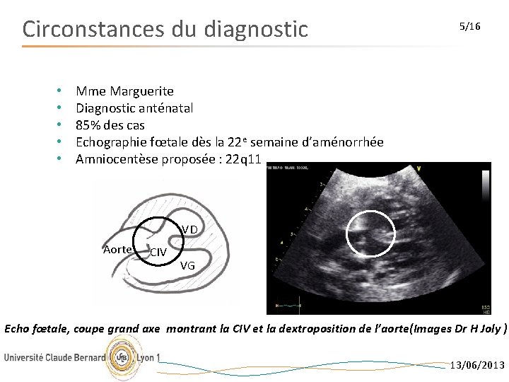 Circonstances du diagnostic • • • 5/16 Mme Marguerite Diagnostic anténatal 85% des cas