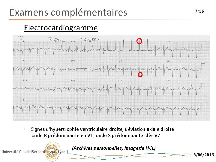 Examens complémentaires 7/16 Electrocardiogramme • Signes d’hypertrophie ventriculaire droite, déviation axiale droite onde R