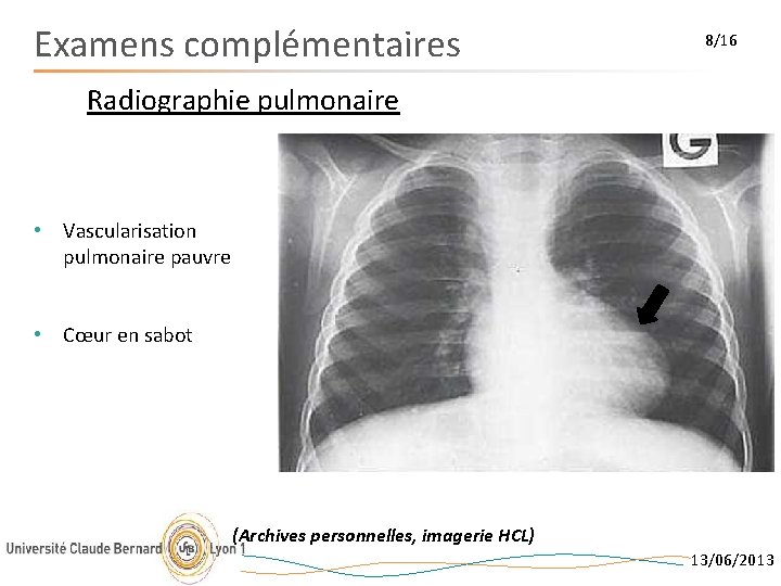Examens complémentaires 8/16 Radiographie pulmonaire • Vascularisation pulmonaire pauvre • Cœur en sabot (Archives