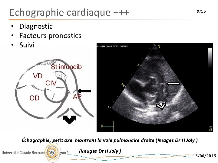 Echographie cardiaque +++ 9/16 • Diagnostic • Facteurs pronostics • Suivi Échographie, petit axe