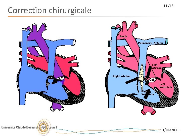 Correction chirurgicale 11/16 13/06/2013 