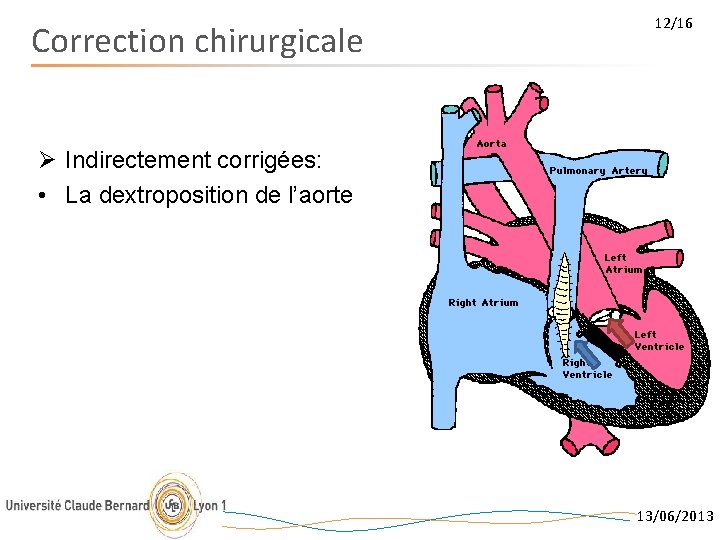 Correction chirurgicale 12/16 Ø Indirectement corrigées: • La dextroposition de l’aorte 13/06/2013 