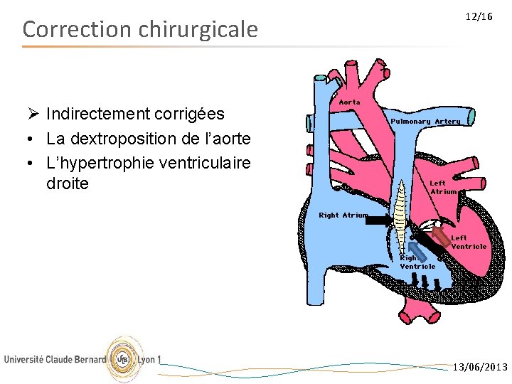 Correction chirurgicale 12/16 Ø Indirectement corrigées • La dextroposition de l’aorte • L’hypertrophie ventriculaire