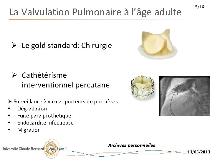 La Valvulation Pulmonaire à l’âge adulte 15/16 Ø Le gold standard: Chirurgie Ø Cathétérisme
