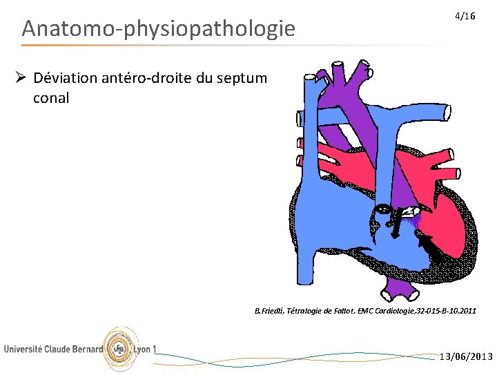 Anatomo-physiopathologie 4/16 Ø Déviation antéro-droite du septum conal B. Friedli, Tétralogie de Fallot, EMC