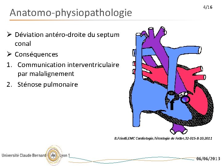 Anatomo-physiopathologie 4/16 Ø Déviation antéro-droite du septum conal Ø Conséquences 1. Communication interventriculaire par