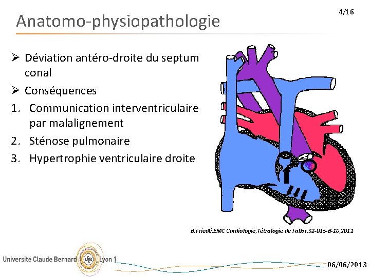 Anatomo-physiopathologie 4/16 Ø Déviation antéro-droite du septum conal Ø Conséquences 1. Communication interventriculaire par