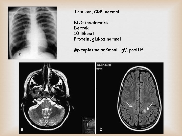 Tam kan, CRP: normal BOS incelemesi: Berrak 10 lökosit Protein, glukoz normal Mycoplasma pnömoni