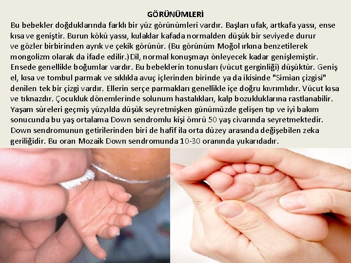 GÖRÜNÜMLERİ Bu bebekler doğduklarında farklı bir yüz görünümleri vardır. Başları ufak, artkafa yassı, ense