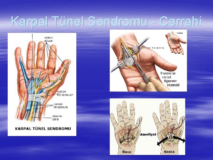 Karpal Tünel Sendromu - Cerrahi 