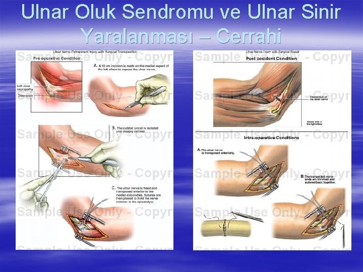 Ulnar Oluk Sendromu ve Ulnar Sinir Yaralanması – Cerrahi 