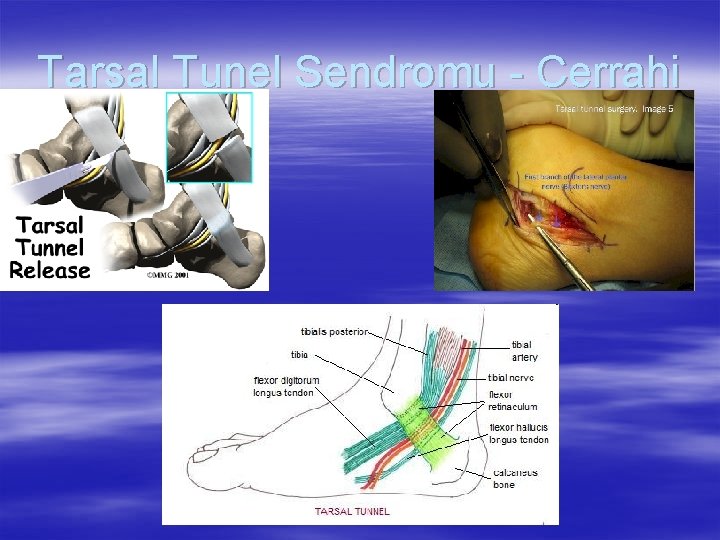 Tarsal Tunel Sendromu - Cerrahi 