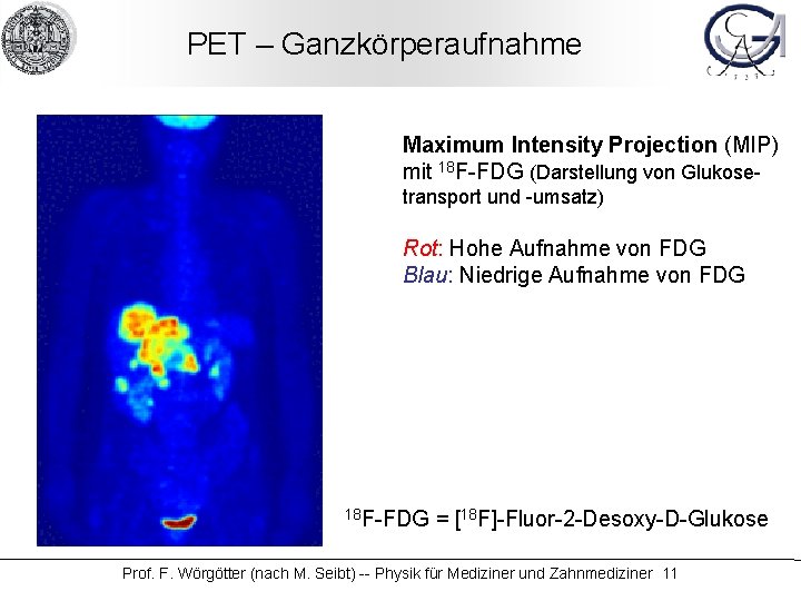 PET – Ganzkörperaufnahme Maximum Intensity Projection (MIP) mit 18 F-FDG (Darstellung von Glukosetransport und