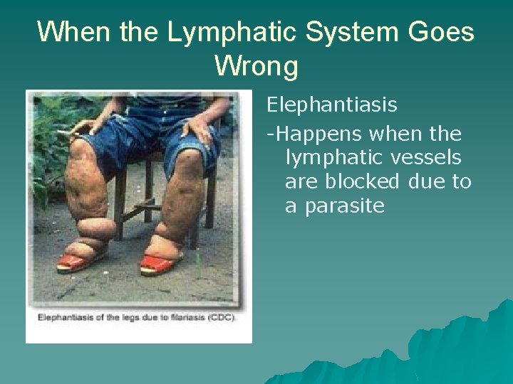 When the Lymphatic System Goes Wrong Elephantiasis -Happens when the lymphatic vessels are blocked