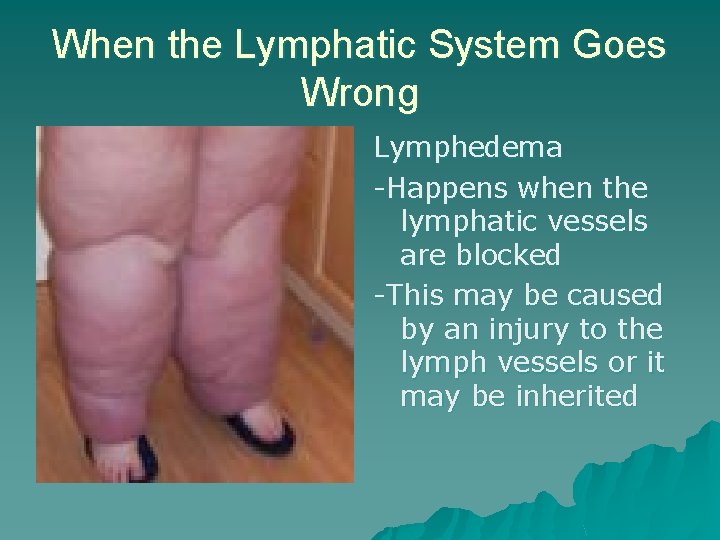 When the Lymphatic System Goes Wrong Lymphedema -Happens when the lymphatic vessels are blocked