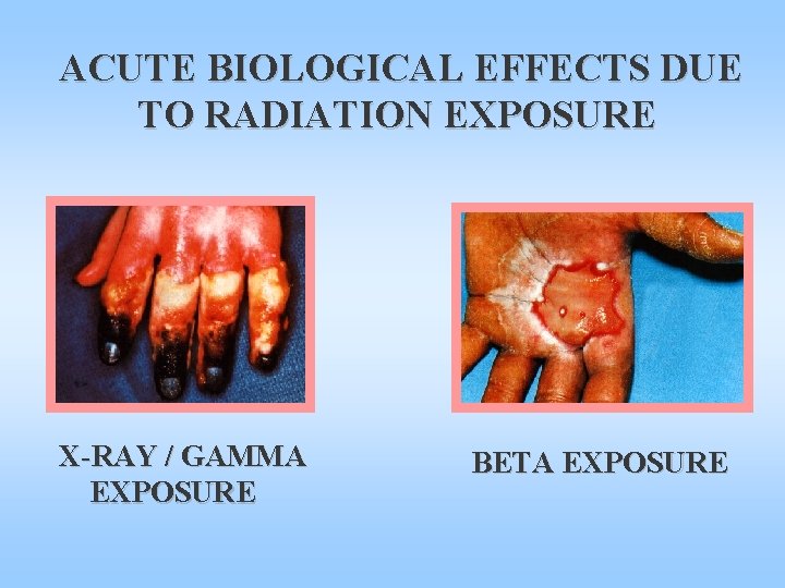 ACUTE BIOLOGICAL EFFECTS DUE TO RADIATION EXPOSURE X-RAY / GAMMA EXPOSURE BETA EXPOSURE 