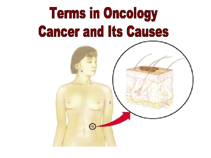 Terms in Oncology & Its Causes 1 