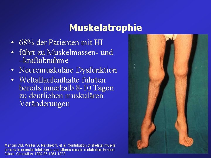 Muskelatrophie • 68% der Patienten mit HI • führt zu Muskelmassen- und –kraftabnahme • Muskelatrophie • 68% der Patienten mit HI • führt zu Muskelmassen- und –kraftabnahme •