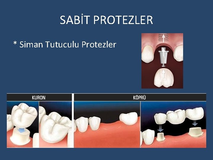 SABİT PROTEZLER * Siman Tutuculu Protezler 