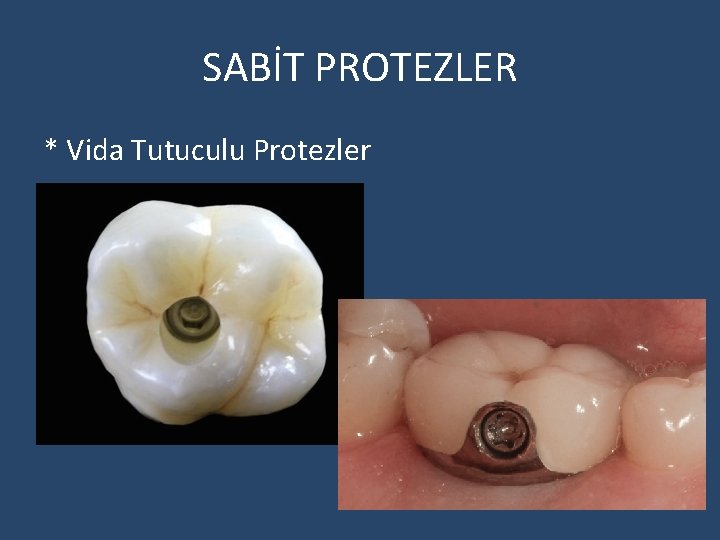 SABİT PROTEZLER * Vida Tutuculu Protezler 