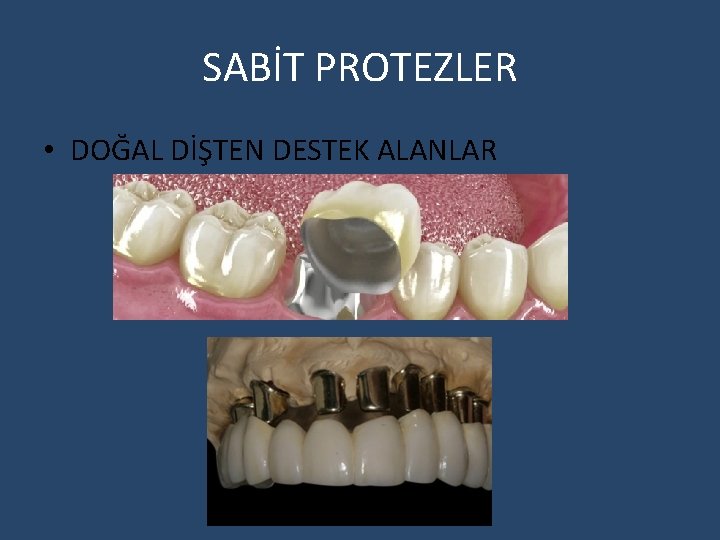 SABİT PROTEZLER • DOĞAL DİŞTEN DESTEK ALANLAR 