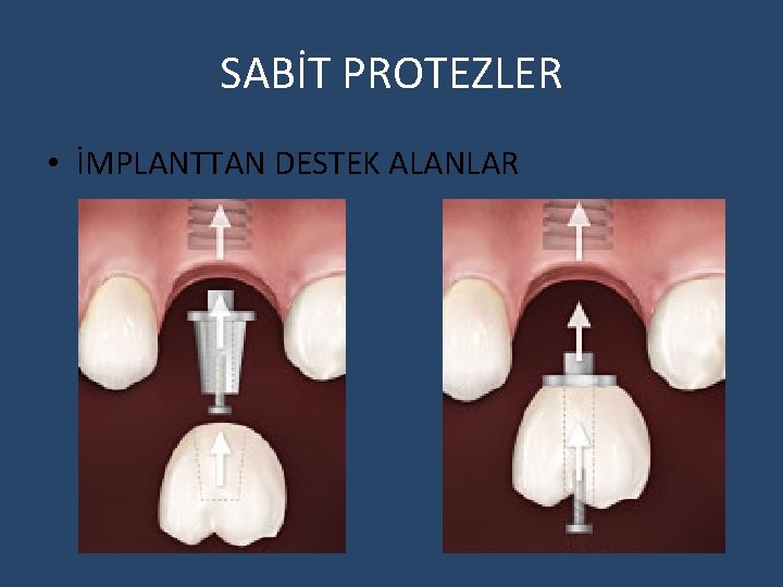 SABİT PROTEZLER • İMPLANTTAN DESTEK ALANLAR 