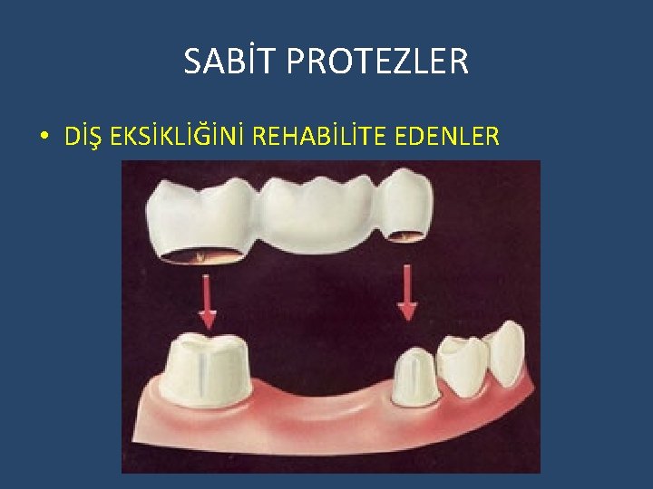 SABİT PROTEZLER • DİŞ EKSİKLİĞİNİ REHABİLİTE EDENLER 