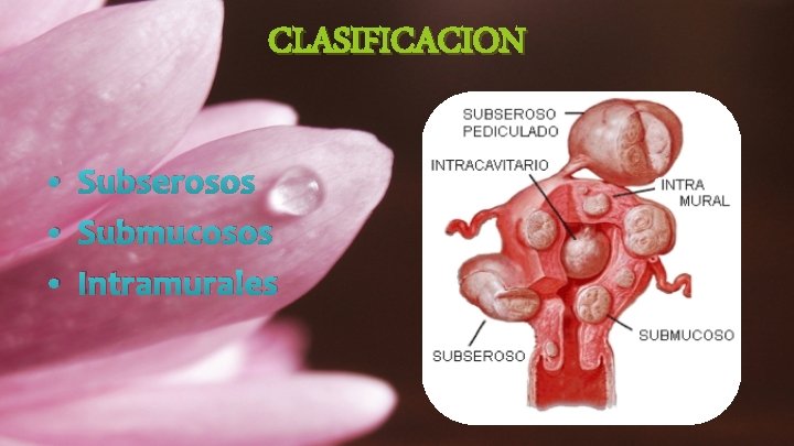 CLASIFICACION • Subserosos • Submucosos • Intramurales 