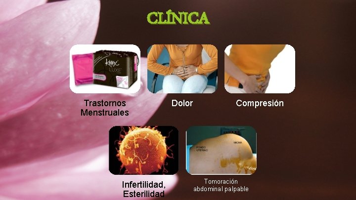 CLÍNICA Trastornos Menstruales Infertilidad, Esterilidad Dolor Compresión Tomoración abdominal palpable 