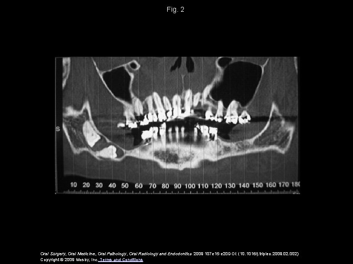 Fig. 2 Oral Surgery, Oral Medicine, Oral Pathology, Oral Radiology and Endodontics 2009 107