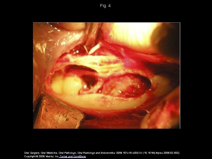 Fig. 4 Oral Surgery, Oral Medicine, Oral Pathology, Oral Radiology and Endodontics 2009 107