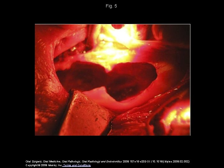 Fig. 5 Oral Surgery, Oral Medicine, Oral Pathology, Oral Radiology and Endodontics 2009 107