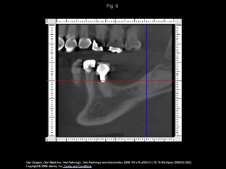 Fig. 8 Oral Surgery, Oral Medicine, Oral Pathology, Oral Radiology and Endodontics 2009 107