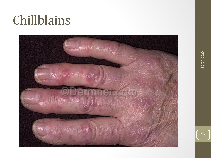 10/29/2020 Chillblains 15 