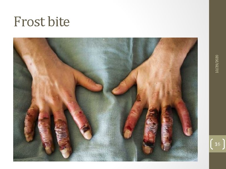 10/29/2020 Frost bite 16 