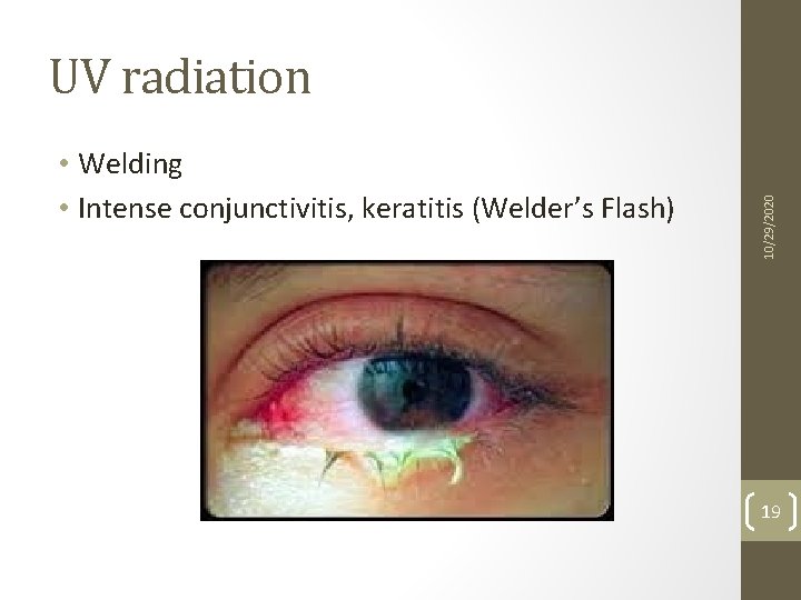  • Welding • Intense conjunctivitis, keratitis (Welder’s Flash) 10/29/2020 UV radiation 19 