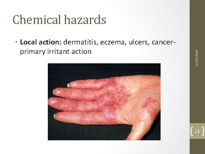  • Local action: dermatitis, eczema, ulcers, cancerprimary irritant action 10/29/2020 Chemical hazards 21