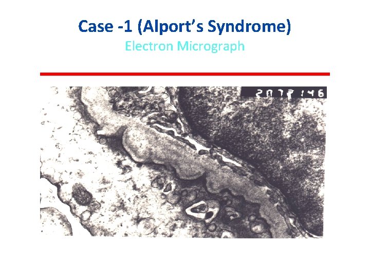 Case -1 (Alport’s Syndrome) Electron Micrograph 