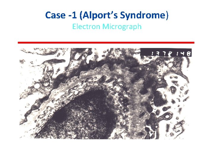 Case -1 (Alport’s Syndrome) Electron Micrograph 