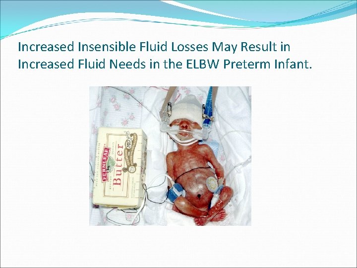 Increased Insensible Fluid Losses May Result in Increased Fluid Needs in the ELBW Preterm