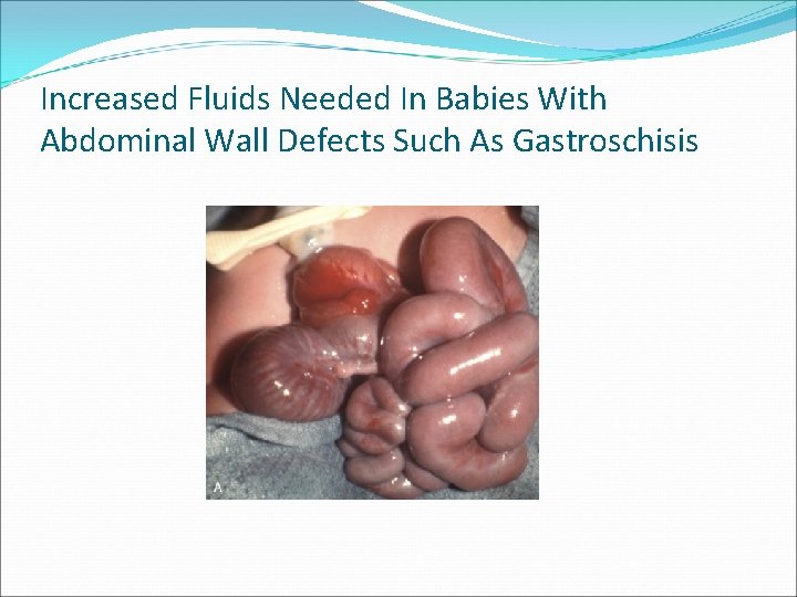 Increased Fluids Needed In Babies With Abdominal Wall Defects Such As Gastroschisis 