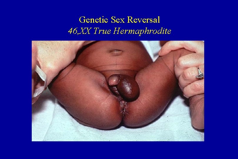 Genetic Sex Reversal 46, XX True Hermaphrodite 
