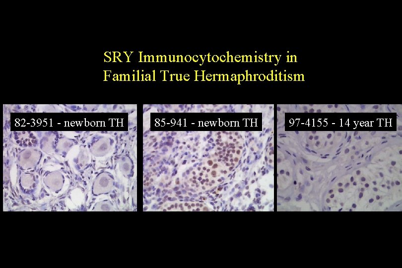 SRY Immunocytochemistry in Familial True Hermaphroditism 82 -3951 - newborn TH 85 -941 -